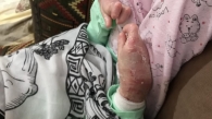 زینب بیمار پروانه ای