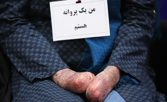 بیماری پروانه ای چیست