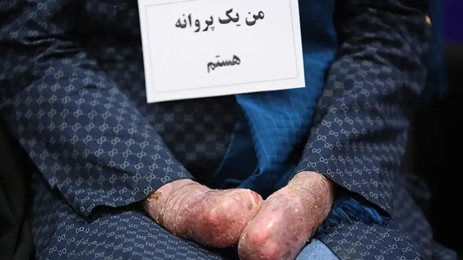 بیماری پروانه ای چیست