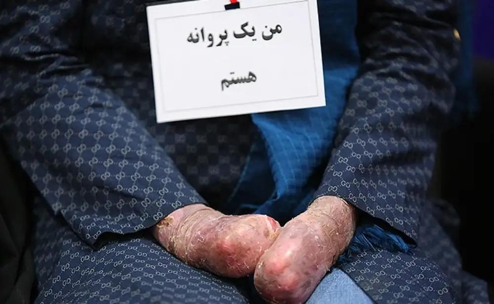 بیماری پروانه ای چیست